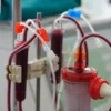 Home Dialysis Systems Market Expected to Expand Significantly at a 10.7% CAGR